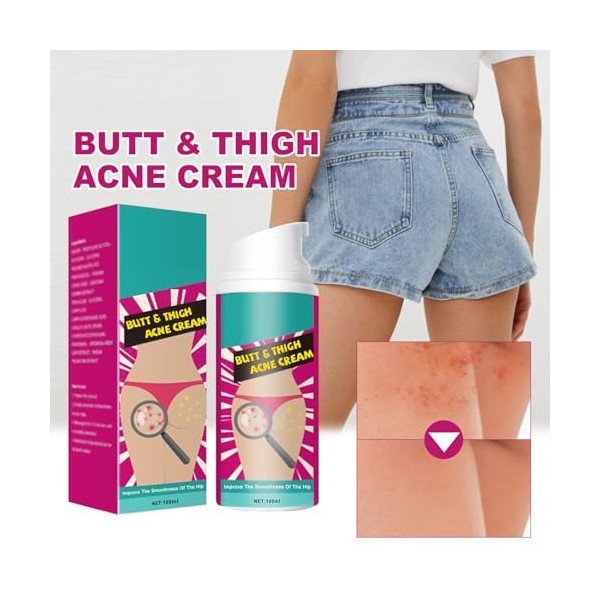 Crème pour les Boutons des Fesses,Lotion de Compensation de lacné des Fesses,Anti-Boutons pour les Fesse,Nettoyante Contre l