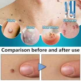 Wart Removal Cream, Crème Anti-Verrues, 20g