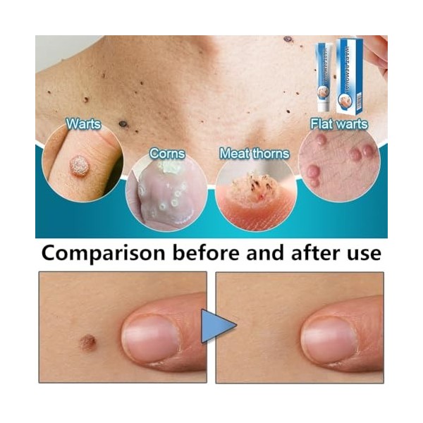 Wart Removal Cream, Crème Anti-Verrues, 20g