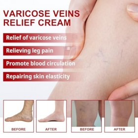 2PC Cream contre les Varicosités, Varicose Vein Repair Crème, pour un Traitement Efficace des Varices Traitement Jambes Crème