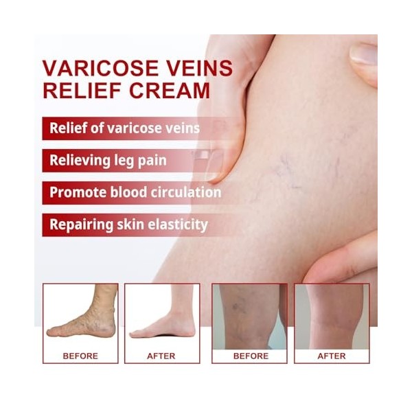 2PC Cream contre les Varicosités, Varicose Vein Repair Crème, pour un Traitement Efficace des Varices Traitement Jambes Crème
