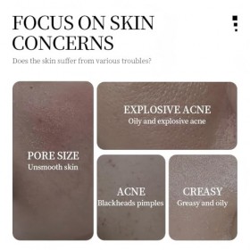 Sérum éclaircissant et hydratant pour le visage, sérum anti-taches et anti-acné, nourrissant doux, peau éclatante et hydratat