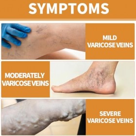 Set Crème Contre Les Varicosités+Intravenous Spray,Réparation Des Jambes DAraignée,Skin Therapy Cream,Traitement Des Varices