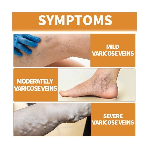 Set Crème Contre Les Varicosités+Intravenous Spray,Réparation Des Jambes DAraignée,Skin Therapy Cream,Traitement Des Varices