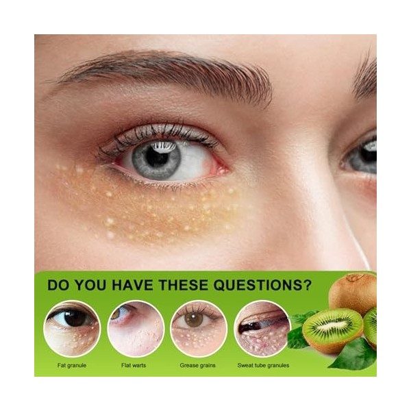2PC Élimine Les Particules De Graisse Sous Les Yeux,Vitamine E Cream Hydratante Pour Les Yeux,Skin Therapy Cream, Milia Remov