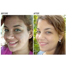 Neoprosone, Sérum à la Vitamine C pour le Visage | 1 Fl oz / 30ml | Sérum Éclaircissant Pour Cernes, Rides | avec Alpha Arbut