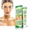 White Tag Treatment Moisturizing Cream, Vitiligo Treatment Repigmentation, Vitiligo Cream for White Spots on Skin, Improve Sk...