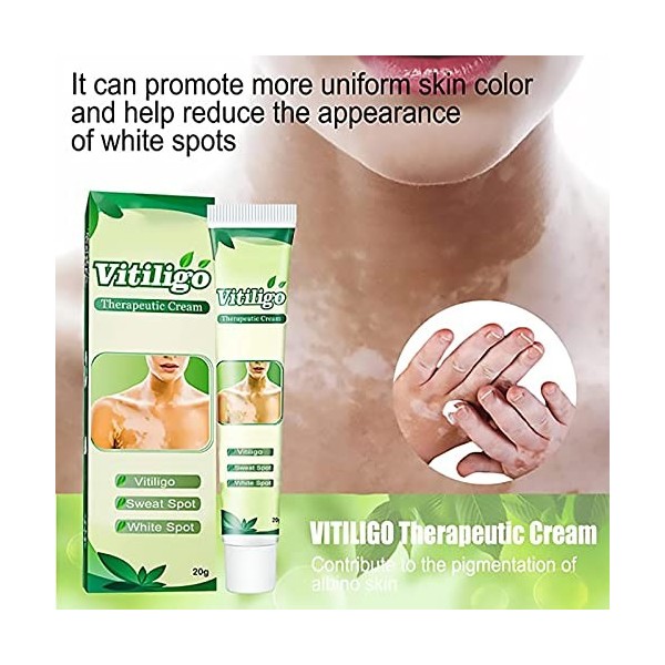 White Tag Treatment Moisturizing Cream, Vitiligo Treatment Repigmentation, Vitiligo Cream for White Spots on Skin, Improve Sk...