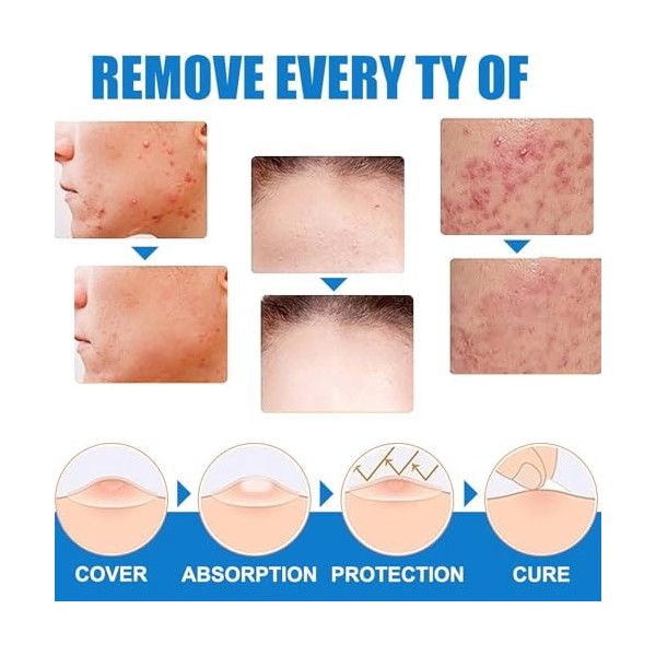 Crème Anti-Verrues, Crème Délimination Instantanée Des Verrues, Wart Removal Cream, Pour Les Types De Peau, 20G