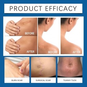 Gel Crème Correcteur de Cicatrices, Cicatrice gel, Crème apaisante, Texture Léger à Absorption Rapide, Cicatrices Réduit la V