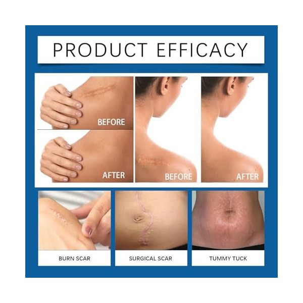 Gel Crème Correcteur de Cicatrices, Cicatrice gel, Crème apaisante, Texture Léger à Absorption Rapide, Cicatrices Réduit la V