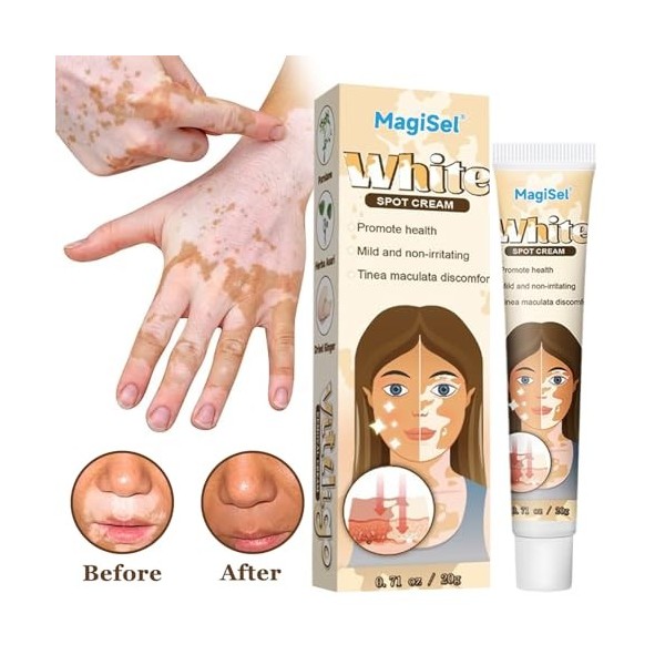 Crème Vitiligo Crème de soin du vitiligo, 20g