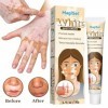 Crème Vitiligo Crème de soin du vitiligo, 20g
