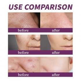 Essence de nicotinamide – Sérum à 20% de niacinamide pour un teint éclatant, une action anti-rides et un resserrement des por...