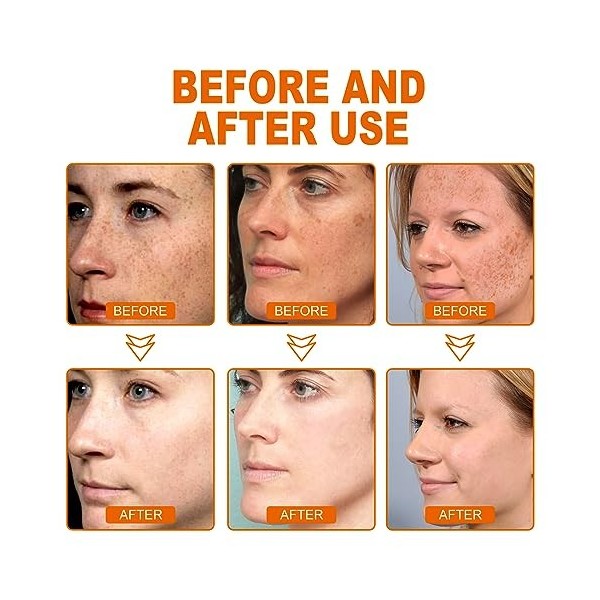 Correcteur de taches brunes, crème éclaircissante pour peaux foncées, crème blanchissante anti-taches de rousseur, avec techn...