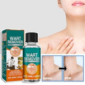 Liquide Délimination Des Verrues,Liquide Anti Verrues,Sérums Délimination Des Acrochordons,Pour Les Types De Peau,30ml