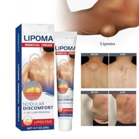 Crème,Crème Délimination Des Lipomes,Doux et Efficace,20g