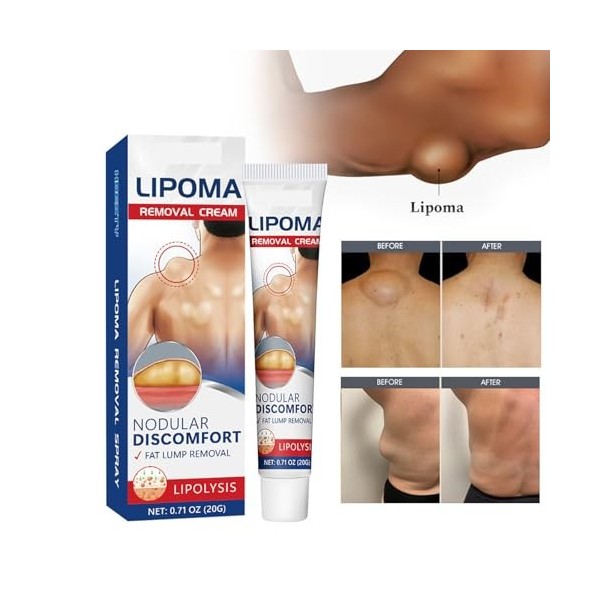 Crème,Crème Délimination Des Lipomes,Doux et Efficace,20g