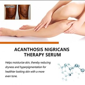 Sérum éclaircissant avancé pour éliminer la mélanose et les taches brunes Blackthorn Repair Essence Essence éclaircissante av...