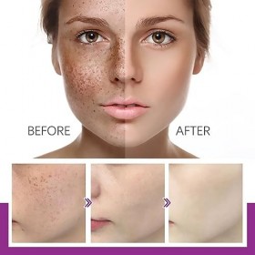 Lot de 3 crèmes pour Las Manchas de La Cara, Cremas para Quitar Manchas de La Cara, Crema Blanqueadora para Pecas, Elimina el