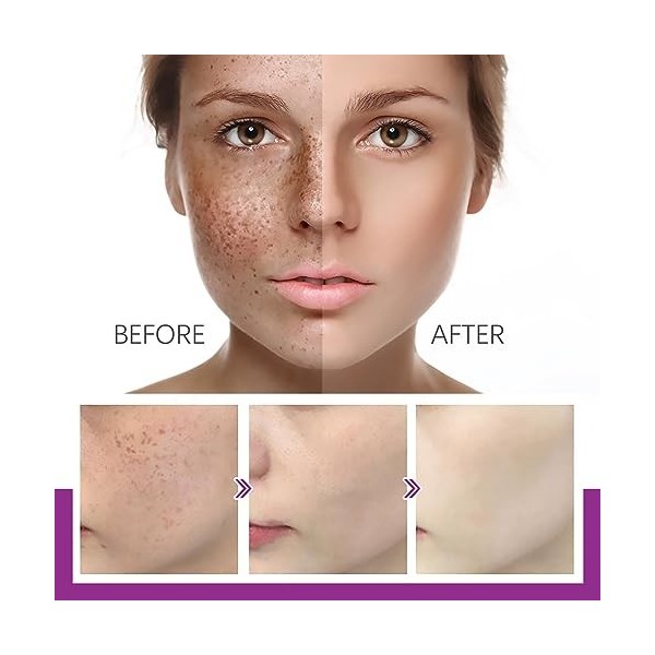 Lot de 3 crèmes pour Las Manchas de La Cara, Cremas para Quitar Manchas de La Cara, Crema Blanqueadora para Pecas, Elimina el