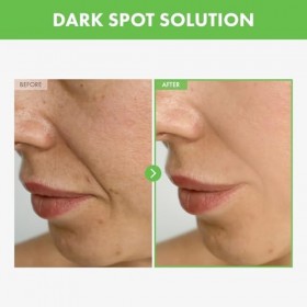 TOSOWOONG Crème anti-taches foncées Kakadu Plum Blemish Cream pour le visage, 50g 1,76 oz