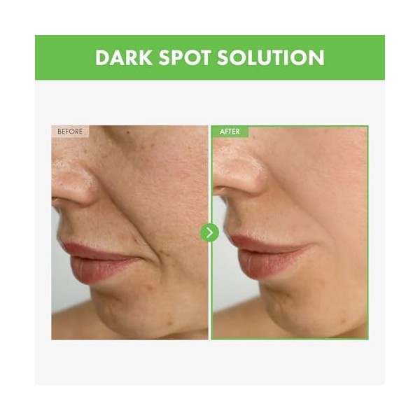 TOSOWOONG Crème anti-taches foncées Kakadu Plum Blemish Cream pour le visage, 50g 1,76 oz