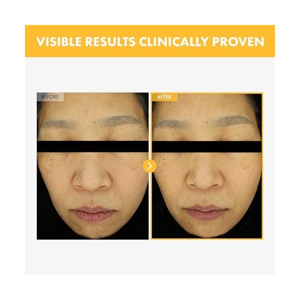 TOSOWOONG Crème anti-taches noires pour le visage Sérum anti-taches de vieillesse pour femmes et hommes 50g 1,76 oz