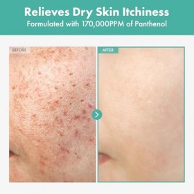 TOSOWOONG Crème de dexpanthénol 170000 ppm B5 Panthénol Madécassoside Centella Asiatica 60ml 2,02 fl. Oz.