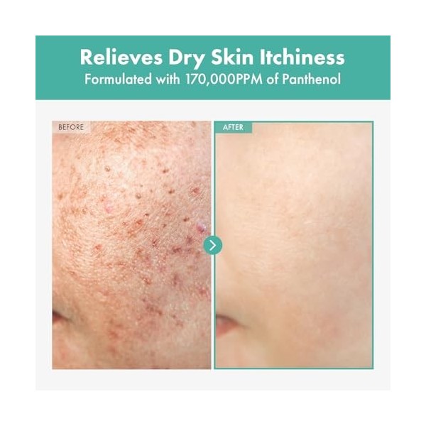 TOSOWOONG Crème de dexpanthénol 170000 ppm B5 Panthénol Madécassoside Centella Asiatica 60ml 2,02 fl. Oz.