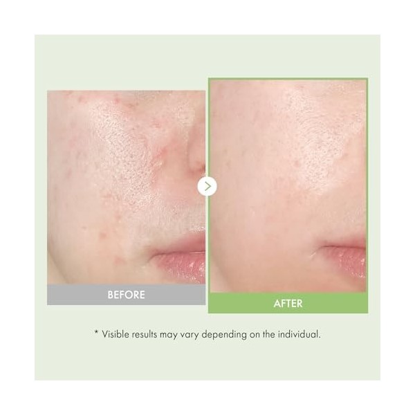 TOSOWOONG Ampoule au noni véritable, 701 518 ppm de jus de feuilles de Noni, Sérum hydratant et nourrissant pour la peau, Hyd