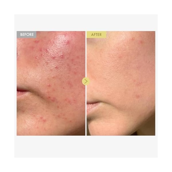 TOSOWOONG Crème pour le visage à 92% de mucine descargot noir, Propolis, Crème hydratante légère pour une peau douce et écla