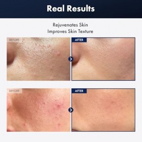 TOSOWOONG Essence descargot noir Plus avec 960,890ppm de filtrat descargot noir, Sérum hydratant, Peau terne et sensible, S