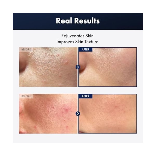 TOSOWOONG Essence descargot noir Plus avec 960,890ppm de filtrat descargot noir, Sérum hydratant, Peau terne et sensible, S