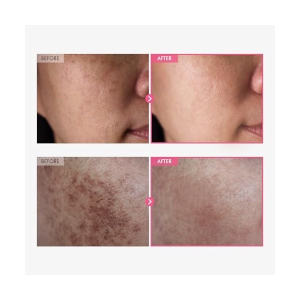 TOSOWOONG Crème Arbutine 7% + Acide Tranexamique 4%, 70000ppm Arbutine, 40000ppm TXA, Niacinamide, Glutathion, Taches, Soin v