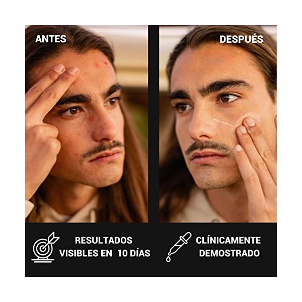 HURRRICANE. Crème anti-acné naturelle pour les hommes. Réduit les boutons et les points noirs. Crème légère avec 29 ingrédien