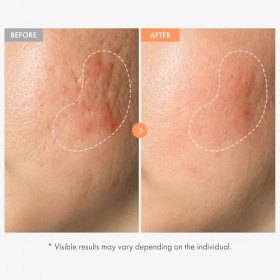 NATUREKIND Ampoule à la niacinamide et à la vitamine- Sérum concentré à 20 000 ppm de vitamine B3, panthénol, Hydratant, Tein