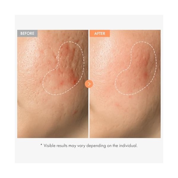 NATUREKIND Ampoule à la niacinamide et à la vitamine- Sérum concentré à 20 000 ppm de vitamine B3, panthénol, Hydratant, Tein