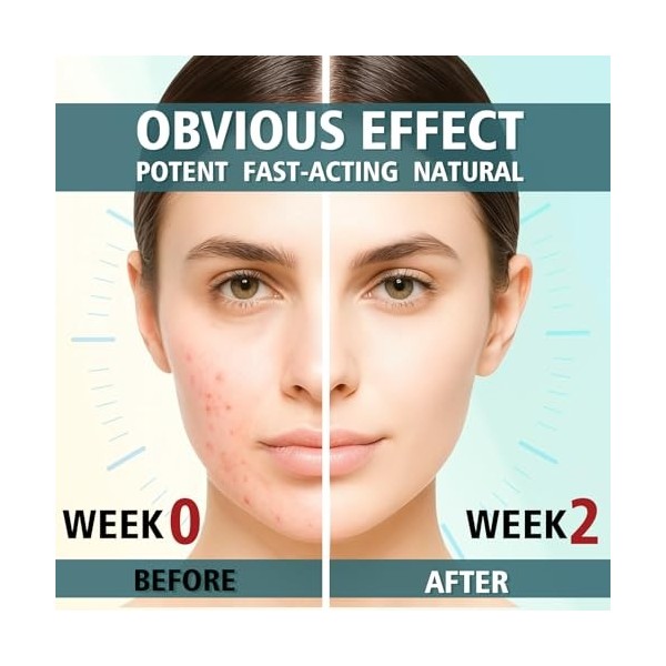 Crème Anti Boutons, Efficace Creme Bouton Visage, Action Rapide Creme Acne Visage, Réduit les Imperfections, Boutons et Point