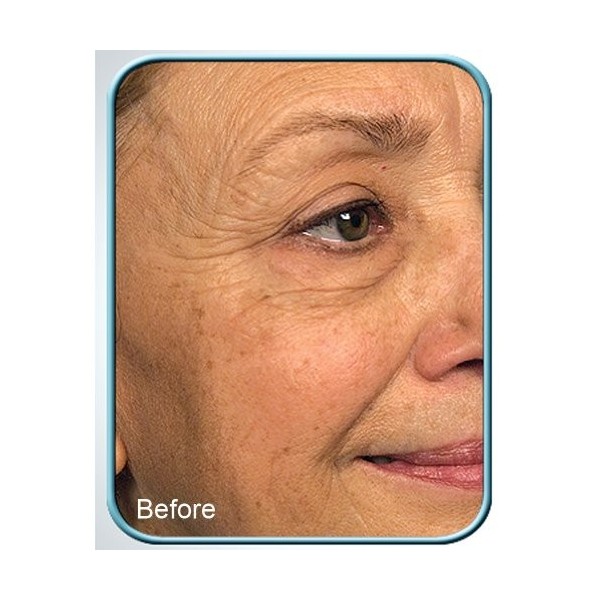 Biologic Stem Cell Therapy Set of 4 Jars for Deep Wrinkles - by BioLogic