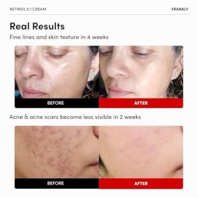 FRANKLY Crème au rétinol 0,3 %, 20,7 ml – Rétinol intensif coréen | Crème de nuit | Céramides et ginseng naturel | Anti-âge, 