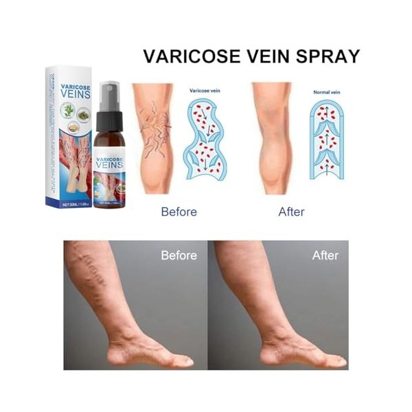 Spray Pour Varices, Varicose Veins Spray, Varicose Veins Cream, Convient À Tous Les Types De Peau, Hydrate, 30ml
