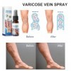 Spray Pour Varices, Varicose Veins Spray, Varicose Veins Cream, Convient À Tous Les Types De Peau, Hydrate, 30ml