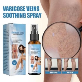 Spray pour Varices - Traitement des Varices et Varicose Veins Spray pour Jambes Légères | Crème Naturelle pour une Circulatio