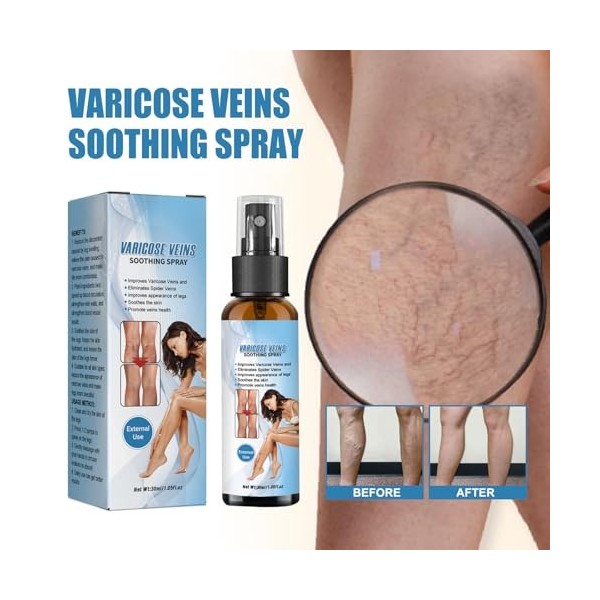 Spray pour Varices - Traitement des Varices et Varicose Veins Spray pour Jambes Légères | Crème Naturelle pour une Circulatio