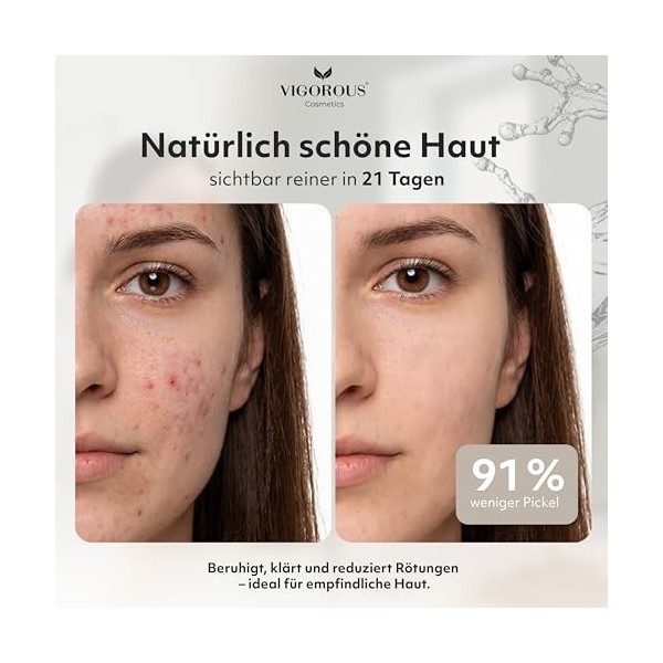 VIGOROUS Tonique pour le visage au zinc 120 ml - Anti-boutons - Pour homme et femme - Acide salicylique et niacinamide - Nett