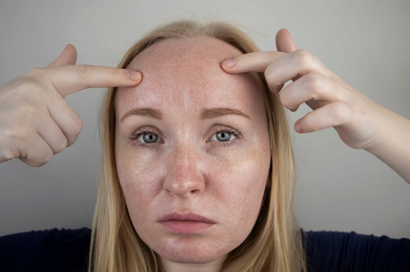 Peau grasse : caractérisée par une brillance excessive et des pores dilatés, nécessitant des soins matifiants spécifiques